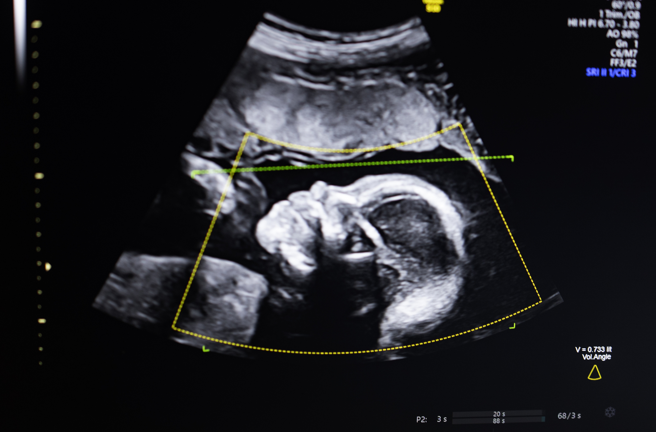 BioticsAI, which won Disrupt’s Battlefield competition in 2023, gains FDA approval for its AI-powered fetal ultrasound product 